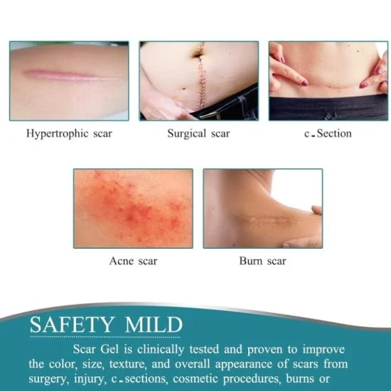 Silicone scar tape | Scar Removal Sheet Strips for C-Section, Acne Scars, Tummy Tuck, Keloid and Surgical Scars | Reusable Medical Grade      Silicone Scar Tape | Get Scars Away Painless Reusable |   Silicone Scar Sheets | Silicone Scar Removal Sheet