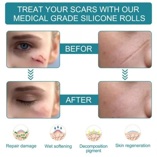 Silicone scar tape | Scar Removal Sheet Strips for C-Section, Acne Scars, Tummy Tuck, Keloid and Surgical Scars | Reusable Medical Grade      Silicone Scar Tape | Get Scars Away Painless Reusable |   Silicone Scar Sheets | Silicone Scar Removal Sheet
